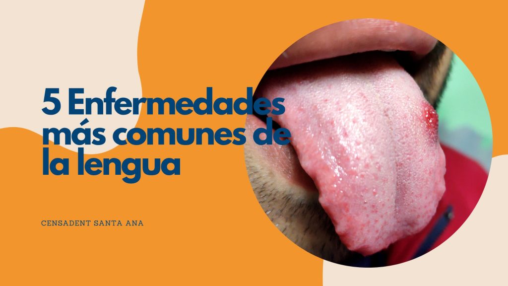 5 Enfermedades más comunes de la lengua
