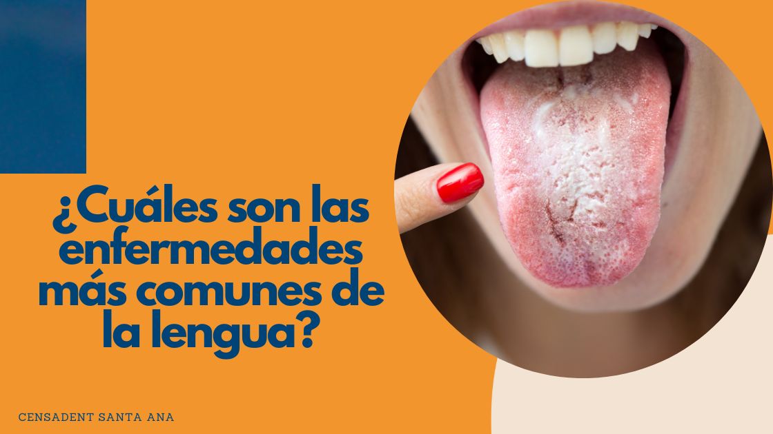 5 enfermedades más comunes de la lengua