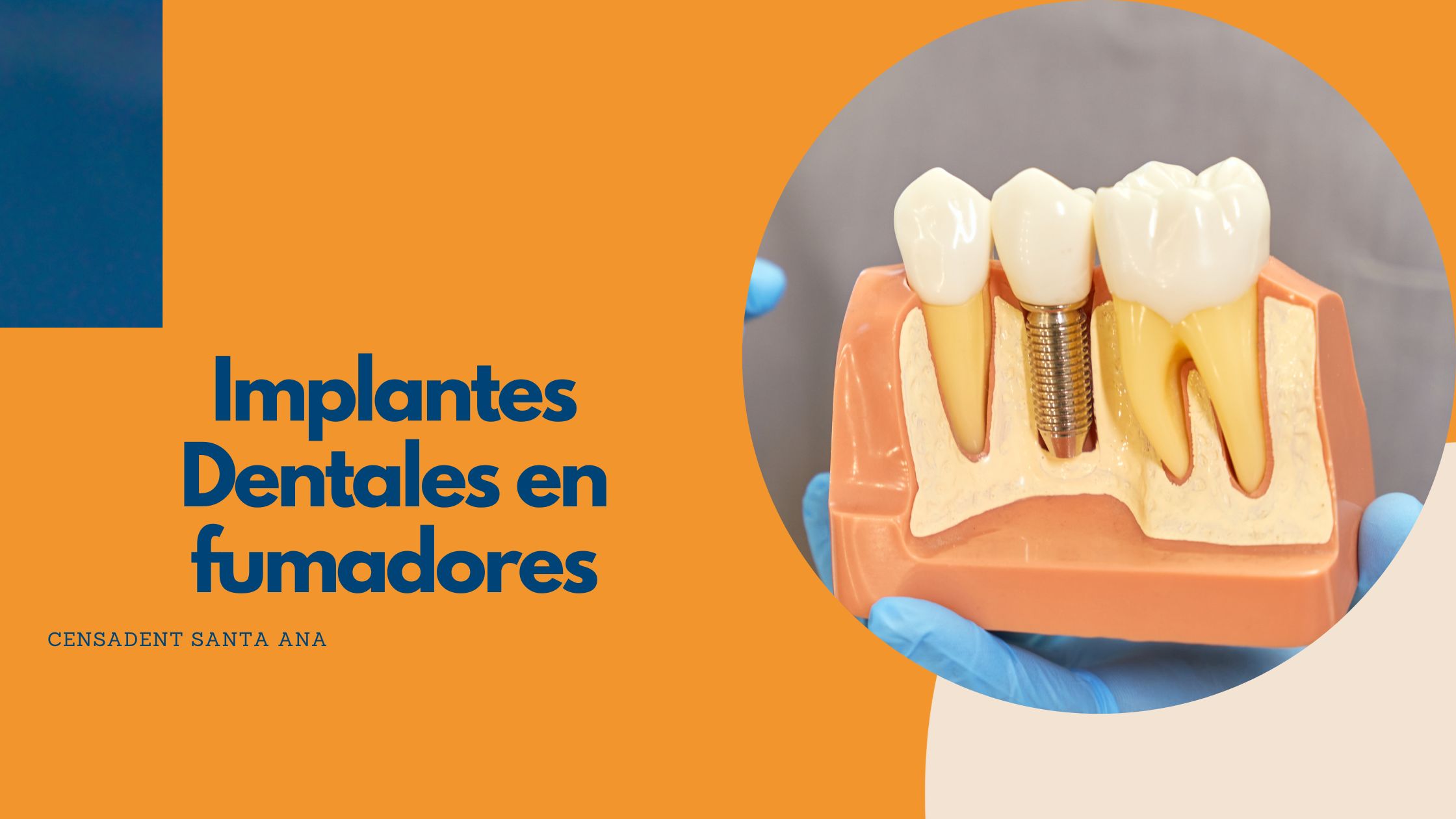 Implantes dentales en fumadores: ¿Cuáles son los riesgos y las recomendaciones?