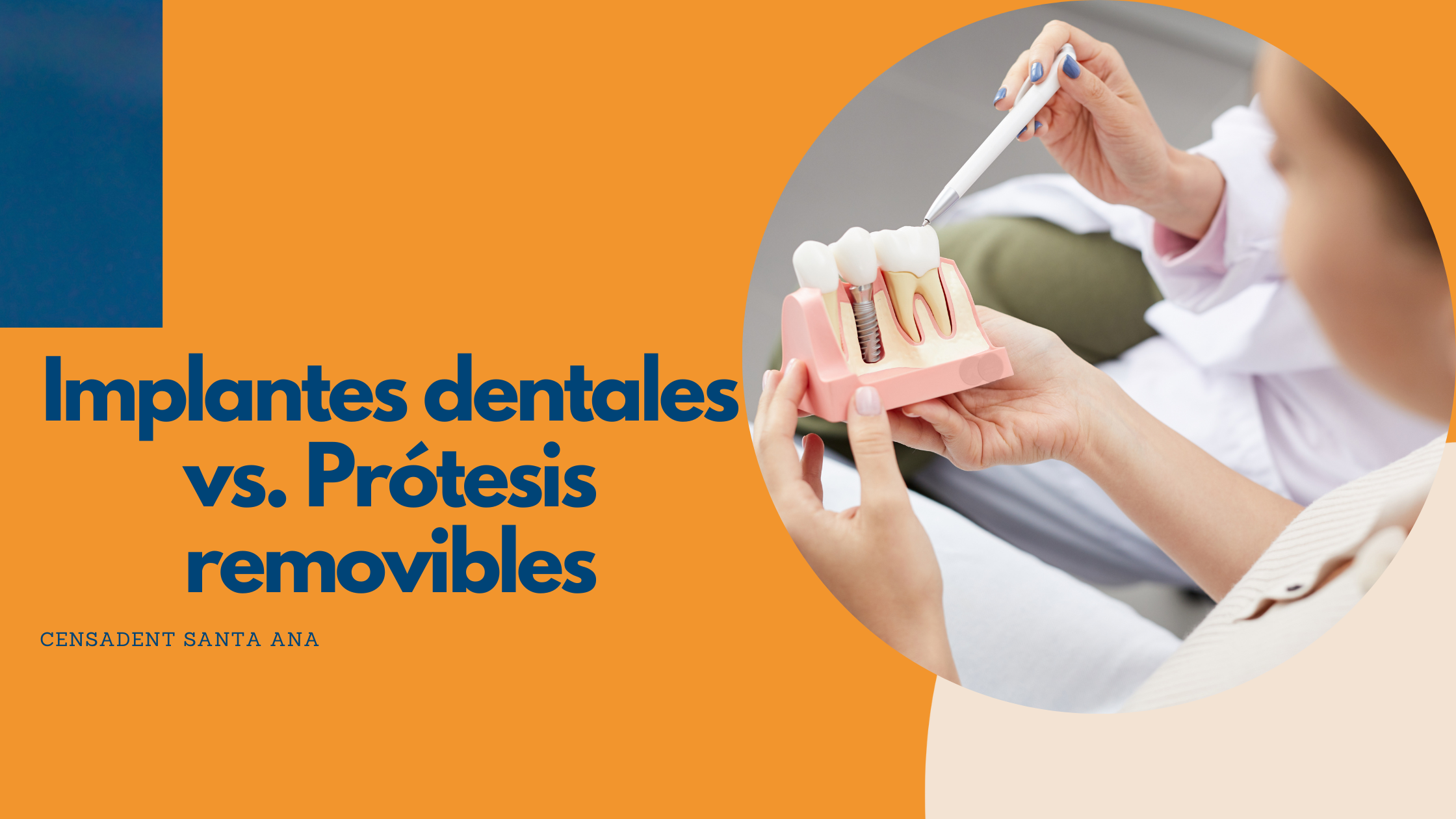 Implantes dentales y Prótesis removibles: ¿Cuál es la mejor opción para ti?