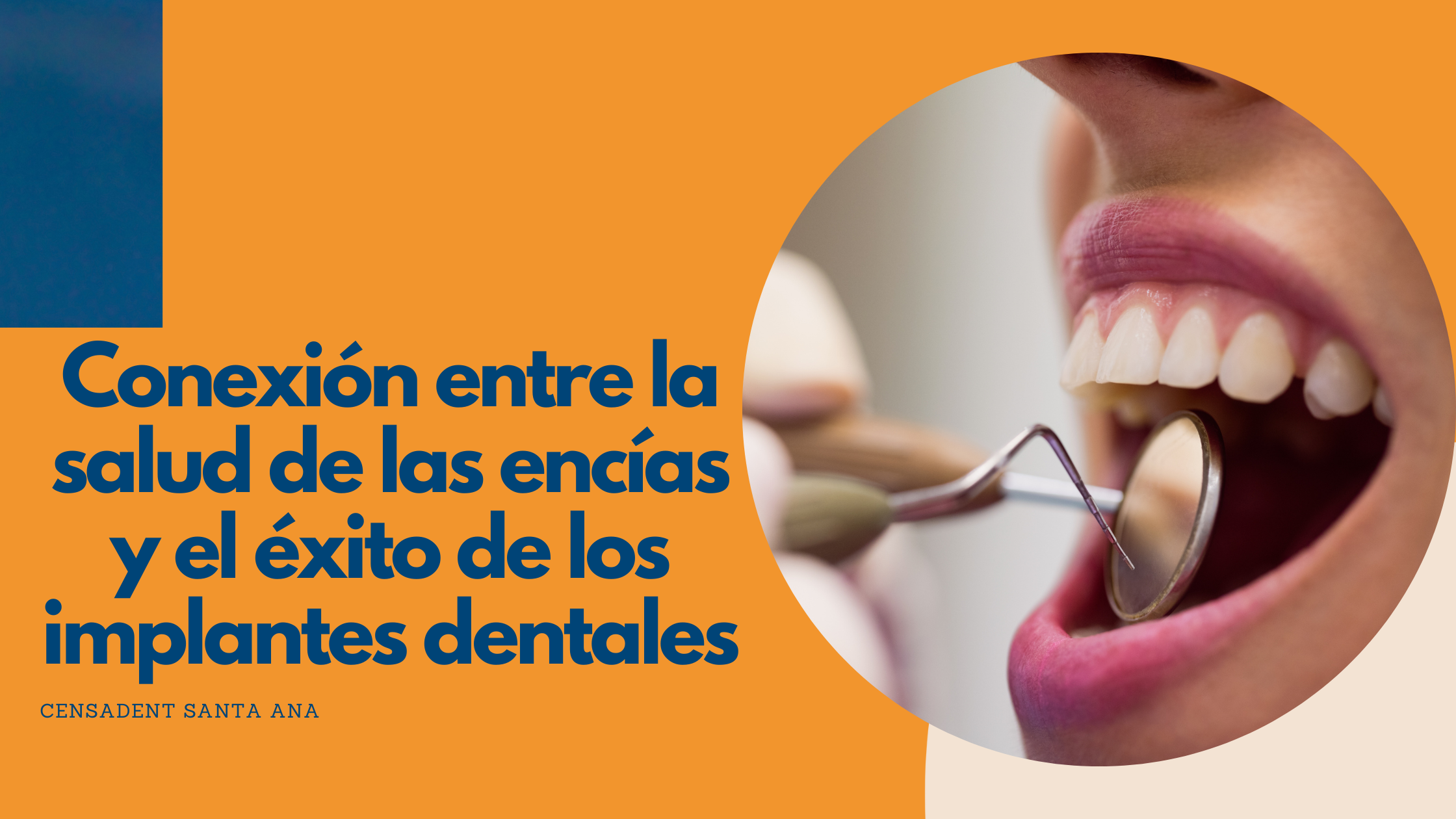 La conexión entre la salud de las encías y el éxito de los implantes dentales
