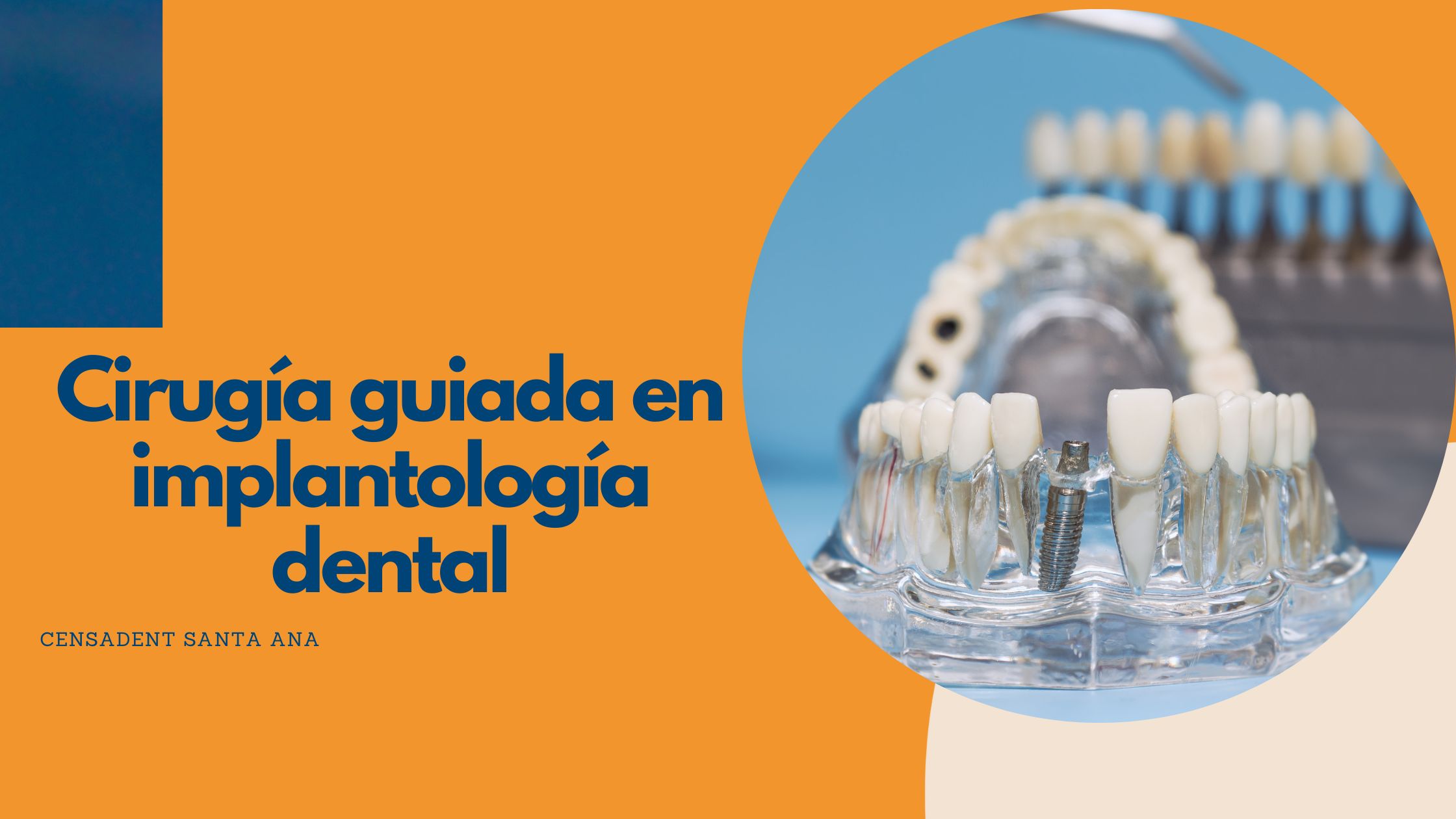 ¿Qué es la cirugía guiada en implantología dental y cómo mejora los resultados?
