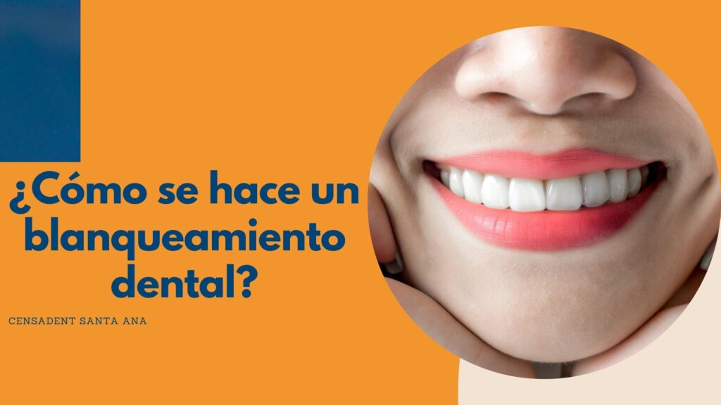 como se hace un blanqueamiento dental
