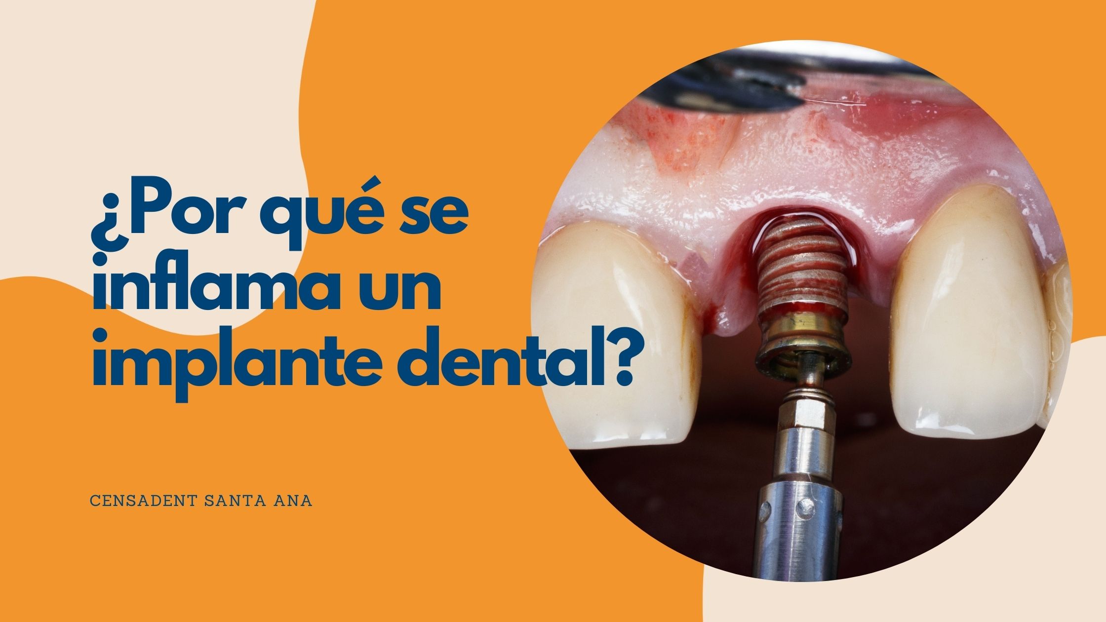 ¿Por qué se inflama un implante dental?