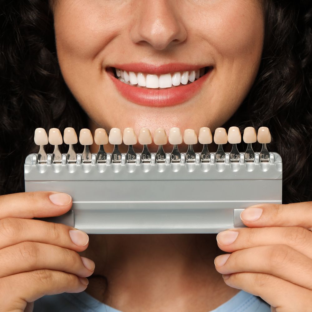 carillas dentales