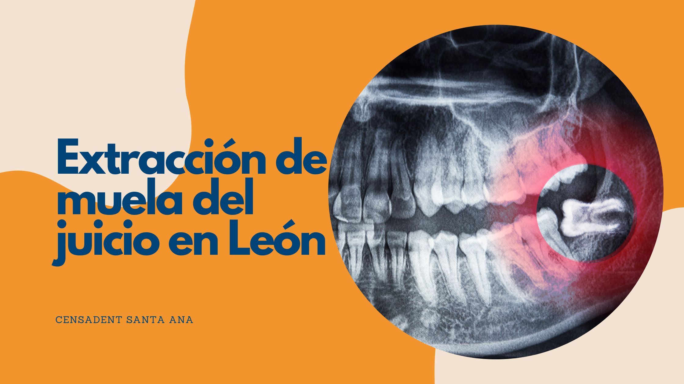 extracción de la muela del juicio